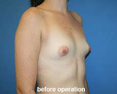 plastic-surgery-breast-augmentation